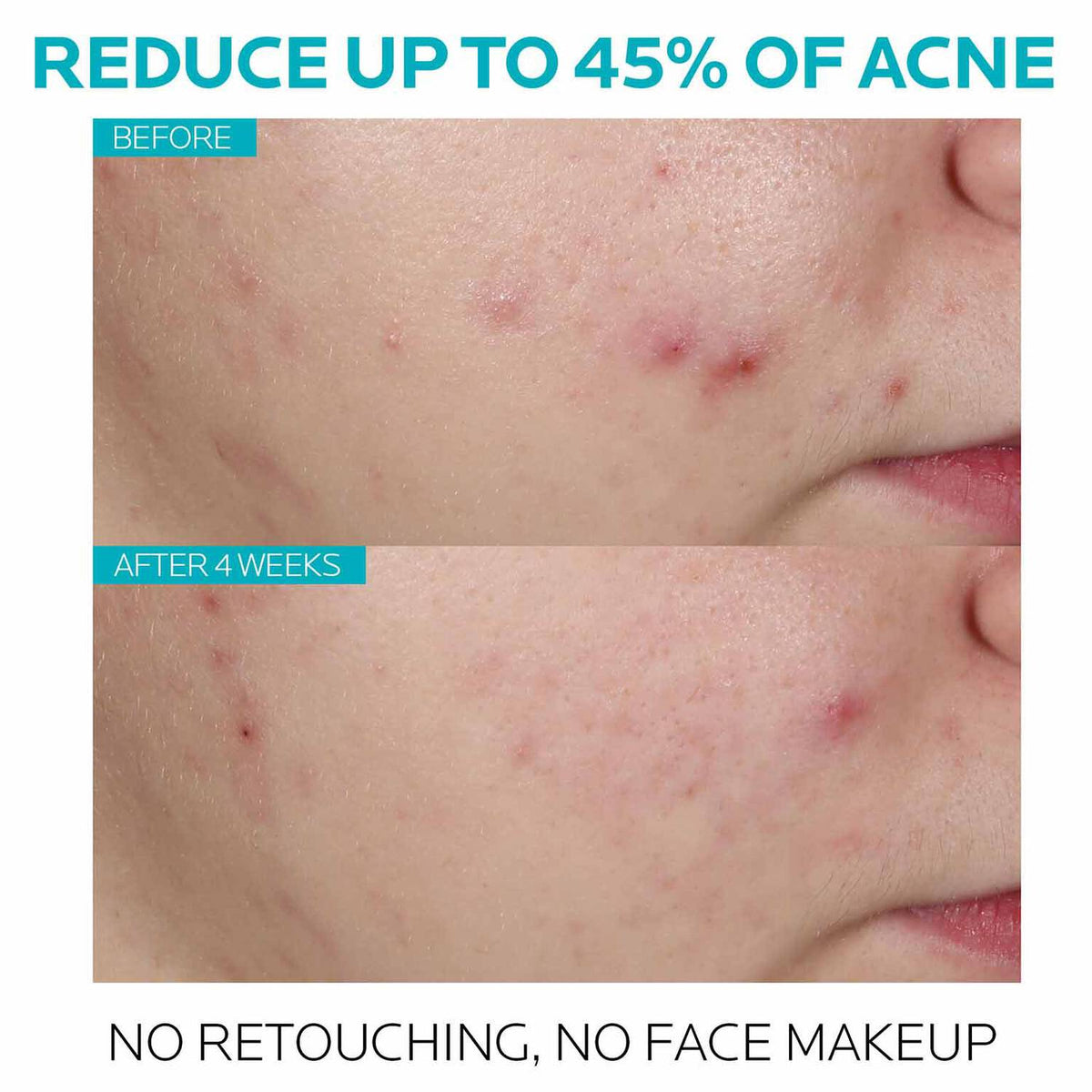 effaclar-salicylic-acid-acne-treatment-serum-l7 7_EffaclarSerum_After-45-days.jpg 7_EffaclarSerum_After-45-days_861b20986157.jpg