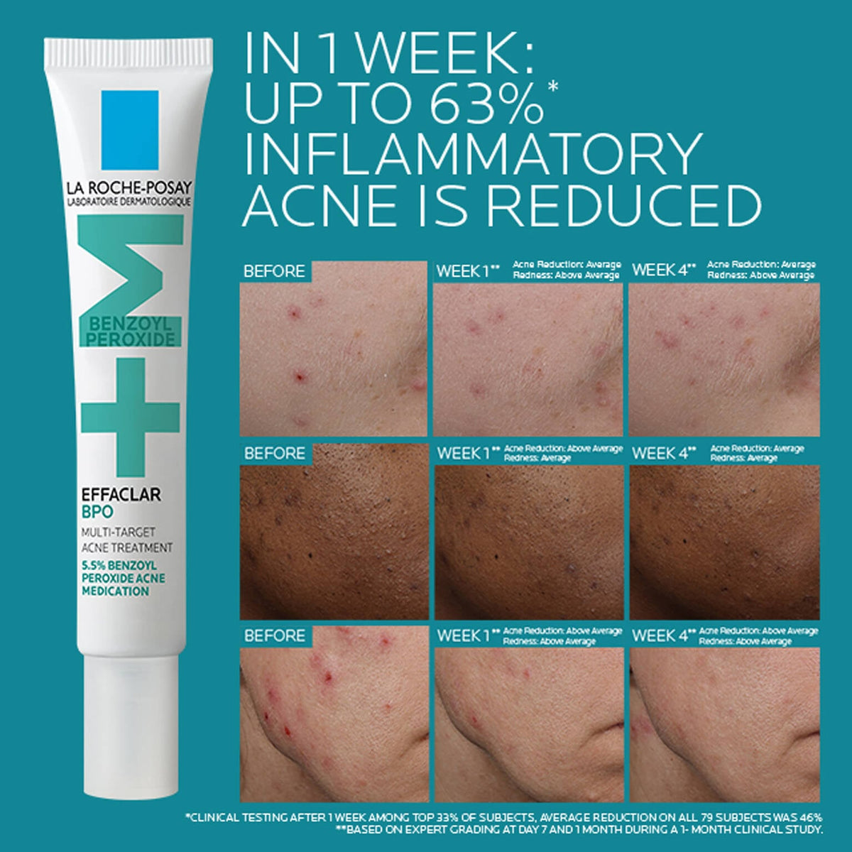 effaclar-bpo-multi-target-acne-treatment-with-5-5-benzoyl-peroxide-a8 EffaclarBPO-ClinicalBA-ATF-1500x1500-2.jpg EffaclarBPO-ClinicalBA-ATF-1500x1500-2_24504e8de09c.jpg
